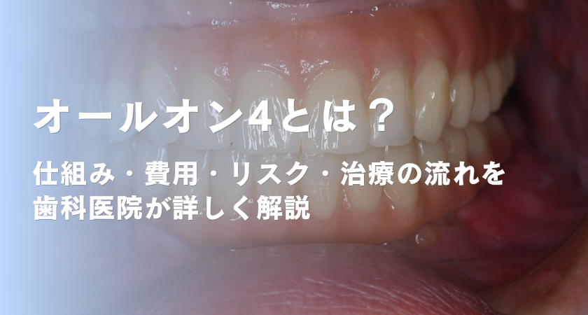 オールオン4とは？仕組み・費用・リスク・治療の流れまで歯科医院が詳しく解説